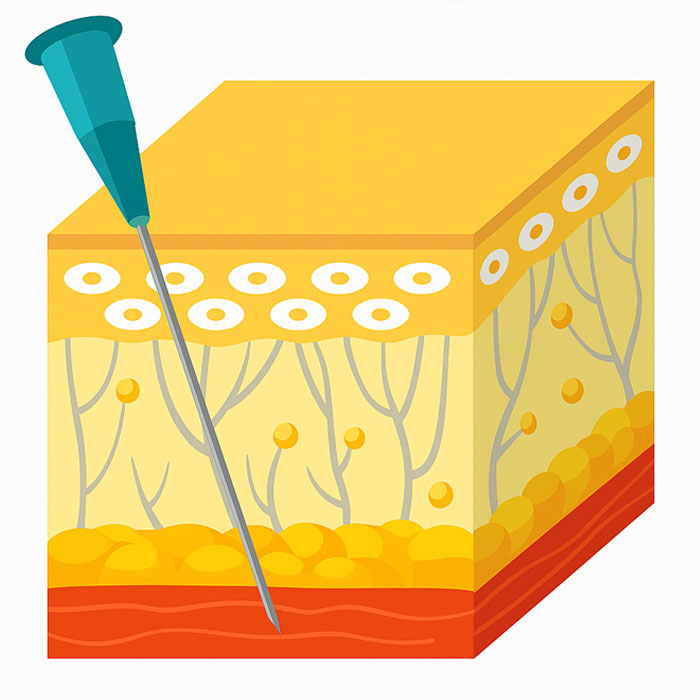 표정근 주입 일러스트