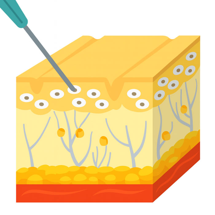 표정근 주입 일러스트